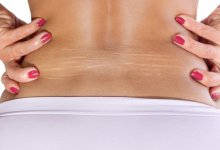 come eliminare le smagliature rosse e bianche
