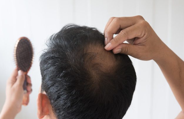 Alopecia: perdita di peli e capelli a chiazze o totale